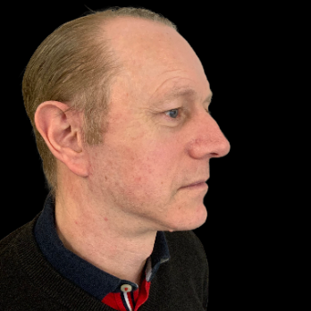 male-facelift-after